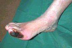 Lymphödem Fuß