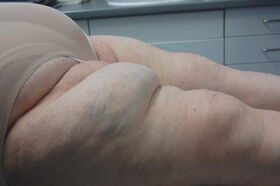 Fetttaschen bei Lipödem