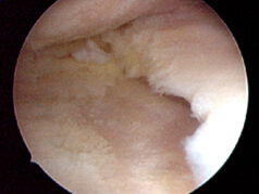 Schwerer Knorpelschaden mit freiliegendem Knochen