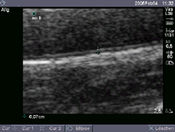 Ultraschall der Halsschlagader: Bestimmung der Gefäßwanddicke
